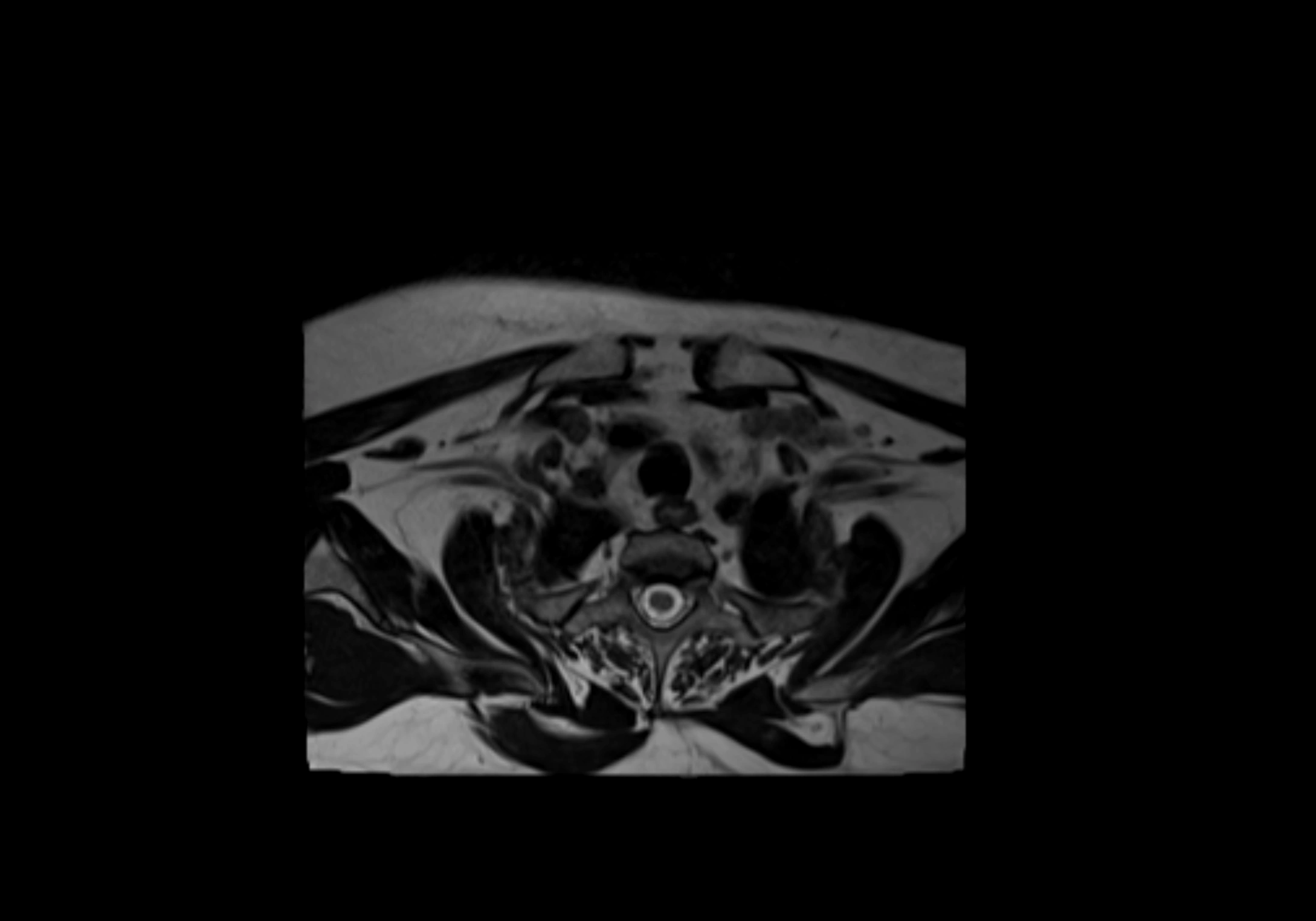 Neck axial  lymph node cross sectional MRI anatomy 3T MRI  image-img-00001-00094.webp
